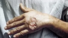 Leishemaiosis: опасност и лечение на болестта